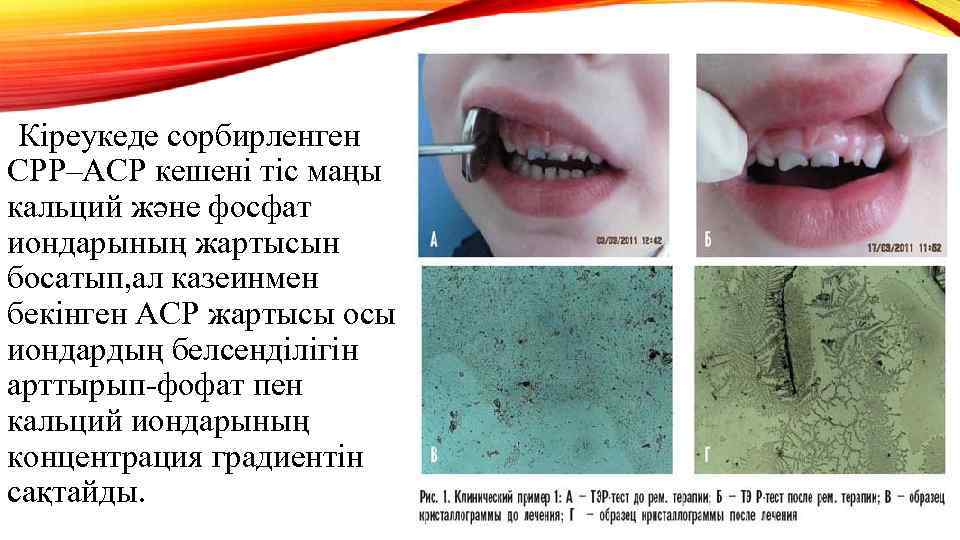 Кіреукеде сорбирленген СРР–АСР кешені тіс маңы кальций және фосфат иондарының жартысын босатып, ал казеинмен