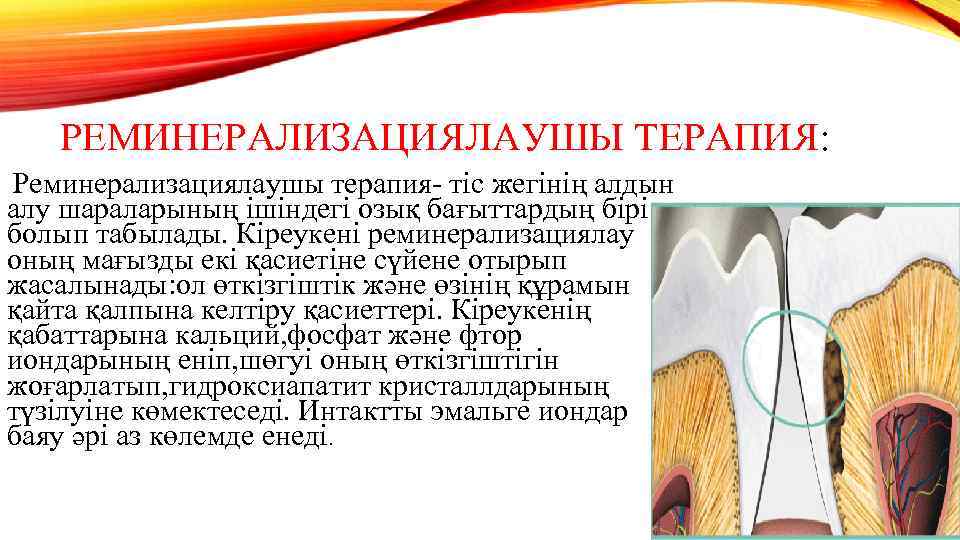 РЕМИНЕРАЛИЗАЦИЯЛАУШЫ ТЕРАПИЯ: Реминерализациялаушы терапия- тіс жегінің алдын алу шараларының ішіндегі озық бағыттардың бірі болып