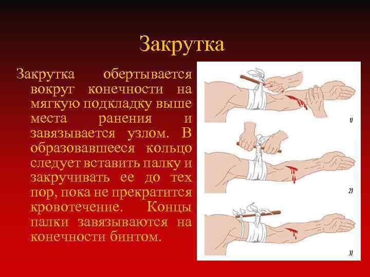 Закрутка обертывается вокруг конечности на мягкую подкладку выше места ранения и завязывается узлом. В