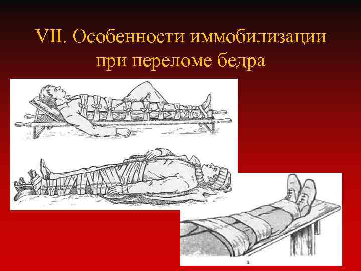 VII. Особенности иммобилизации при переломе бедра 