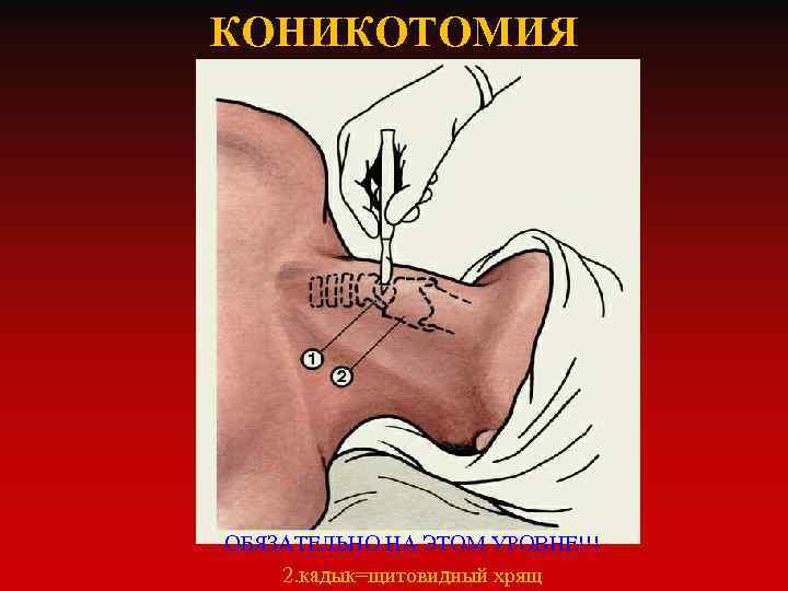 КОНИКОТОМИЯ ОБЯЗАТЕЛЬНО НА ЭТОМ УРОВНЕ!!! 2. кадык=щитовидный хрящ 