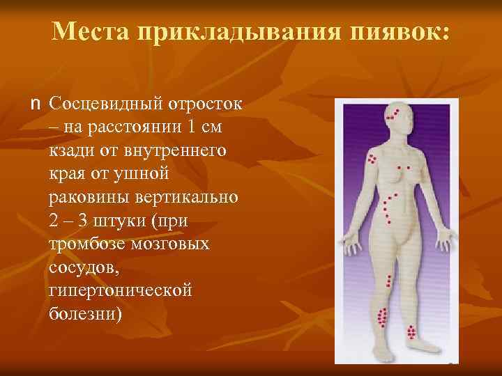 Места прикладывания пиявок: n Сосцевидный отросток – на расстоянии 1 см кзади от внутреннего