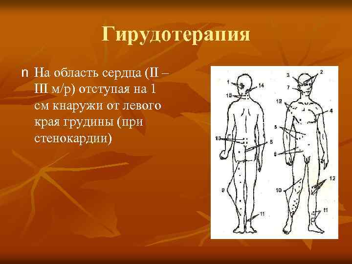 Гирудотерапия n На область сердца (II – III м/р) отступая на 1 см кнаружи