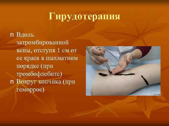 Гирудотерапия n Вдоль затромбированной вены, отступя 1 см от ее краев в шахматном порядке