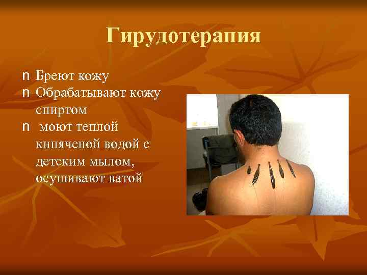 Гирудотерапия n Бреют кожу n Обрабатывают кожу спиртом n моют теплой кипяченой водой с