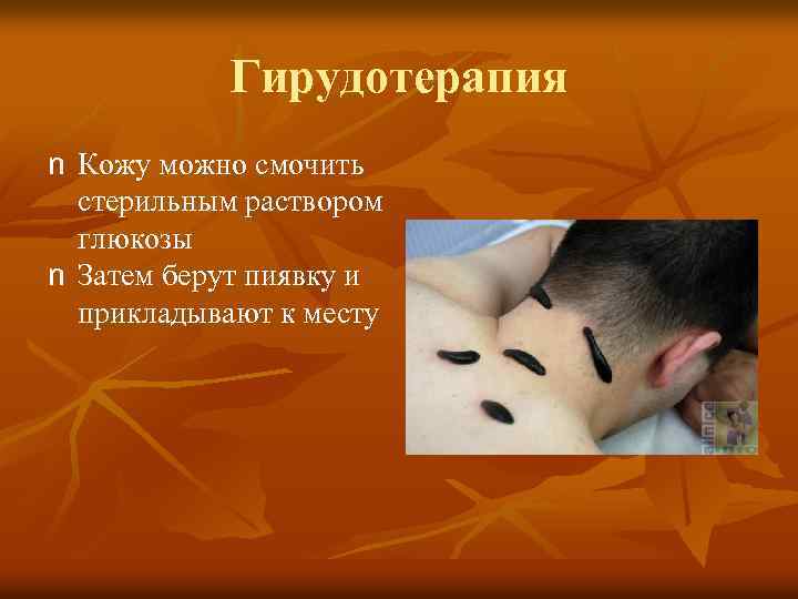 Гирудотерапия n Кожу можно смочить стерильным раствором глюкозы n Затем берут пиявку и прикладывают