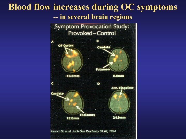 Blood flow increases during OC symptoms -- in several brain regions 