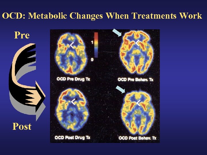 OCD: Metabolic Changes When Treatments Work Pre Post 