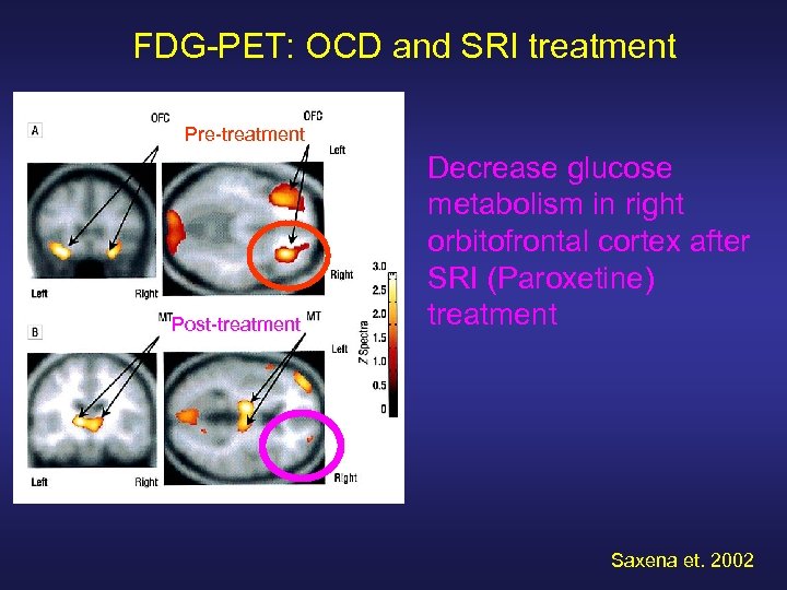 FDG-PET: OCD and SRI treatment Pre-treatment Post-treatment Decrease glucose metabolism in right orbitofrontal cortex