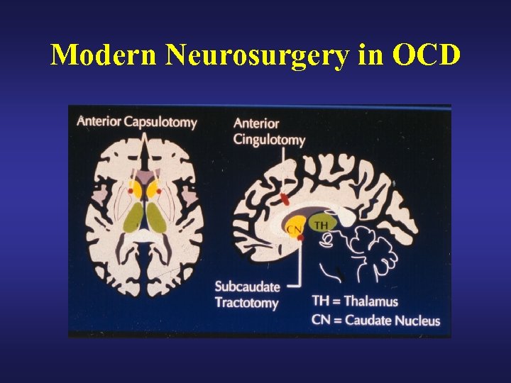 Modern Neurosurgery in OCD 