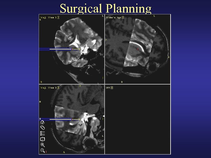 Surgical Planning 