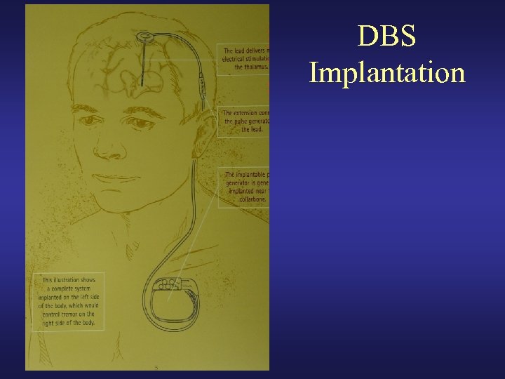 DBS Implantation 