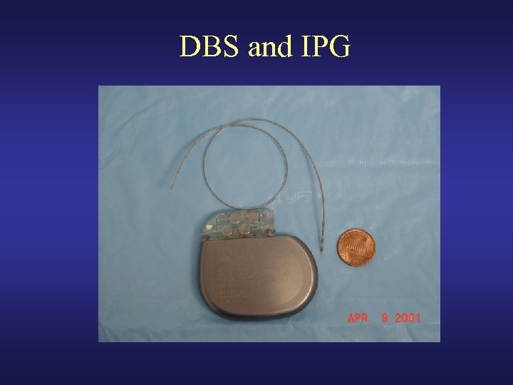 DBS and IPG 