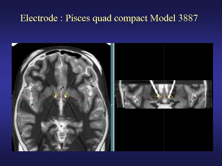 Electrode : Pisces quad compact Model 3887 