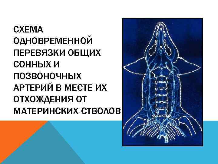 СХЕМА ОДНОВРЕМЕННОЙ ПЕРЕВЯЗКИ ОБЩИХ СОННЫХ И ПОЗВОНОЧНЫХ АРТЕРИЙ В МЕСТЕ ИХ ОТХОЖДЕНИЯ ОТ МАТЕРИНСКИХ