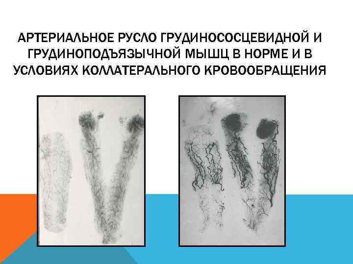 АРТЕРИАЛЬНОЕ РУСЛО ГРУДИНОСОСЦЕВИДНОЙ И ГРУДИНОПОДЪЯЗЫЧНОЙ МЫШЦ В НОРМЕ И В УСЛОВИЯХ КОЛЛАТЕРАЛЬНОГО КРОВООБРАЩЕНИЯ 