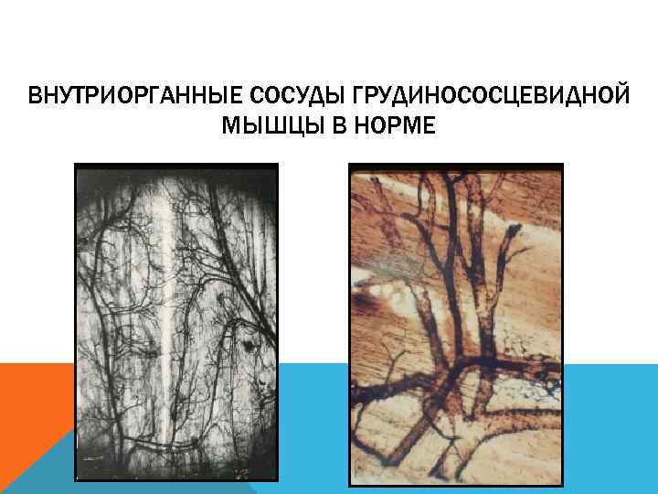 ВНУТРИОРГАННЫЕ СОСУДЫ ГРУДИНОСОСЦЕВИДНОЙ МЫШЦЫ В НОРМЕ 