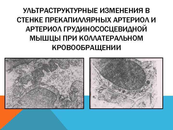 УЛЬТРАСТРУКТУРНЫЕ ИЗМЕНЕНИЯ В СТЕНКЕ ПРЕКАПИЛЛЯРНЫХ АРТЕРИОЛ И АРТЕРИОЛ ГРУДИНОСОСЦЕВИДНОЙ МЫШЦЫ ПРИ КОЛЛАТЕРАЛЬНОМ КРОВООБРАЩЕНИИ 