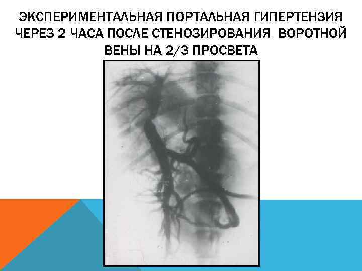 ЭКСПЕРИМЕНТАЛЬНАЯ ПОРТАЛЬНАЯ ГИПЕРТЕНЗИЯ ЧЕРЕЗ 2 ЧАСА ПОСЛЕ СТЕНОЗИРОВАНИЯ ВОРОТНОЙ ВЕНЫ НА 2/3 ПРОСВЕТА 