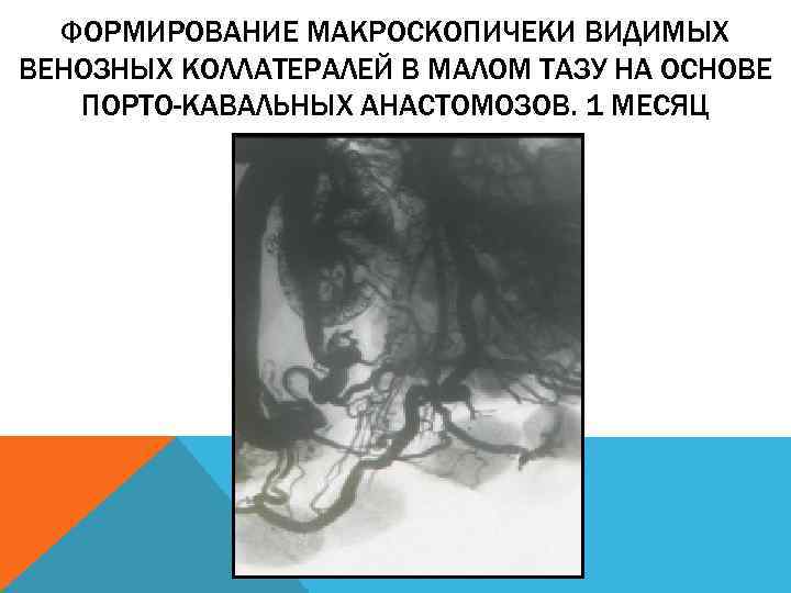 ФОРМИРОВАНИЕ МАКРОСКОПИЧЕКИ ВИДИМЫХ ВЕНОЗНЫХ КОЛЛАТЕРАЛЕЙ В МАЛОМ ТАЗУ НА ОСНОВЕ ПОРТО-КАВАЛЬНЫХ АНАСТОМОЗОВ. 1 МЕСЯЦ