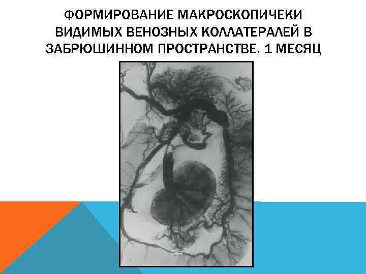 ФОРМИРОВАНИЕ МАКРОСКОПИЧЕКИ ВИДИМЫХ ВЕНОЗНЫХ КОЛЛАТЕРАЛЕЙ В ЗАБРЮШИННОМ ПРОСТРАНСТВЕ. 1 МЕСЯЦ 