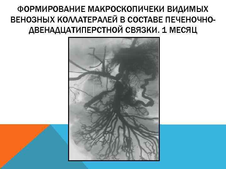 ФОРМИРОВАНИЕ МАКРОСКОПИЧЕКИ ВИДИМЫХ ВЕНОЗНЫХ КОЛЛАТЕРАЛЕЙ В СОСТАВЕ ПЕЧЕНОЧНОДВЕНАДЦАТИПЕРСТНОЙ СВЯЗКИ. 1 МЕСЯЦ 