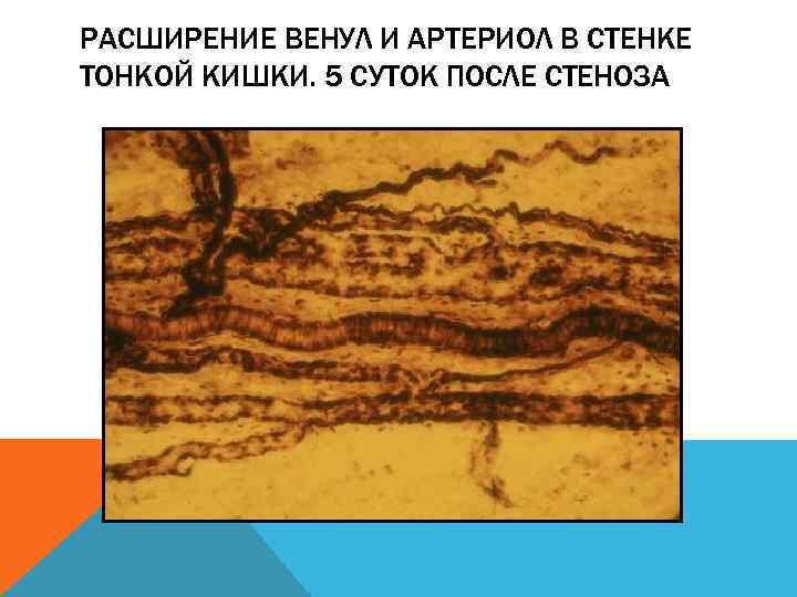 РАСШИРЕНИЕ ВЕНУЛ И АРТЕРИОЛ В СТЕНКЕ ТОНКОЙ КИШКИ. 5 СУТОК ПОСЛЕ СТЕНОЗА 