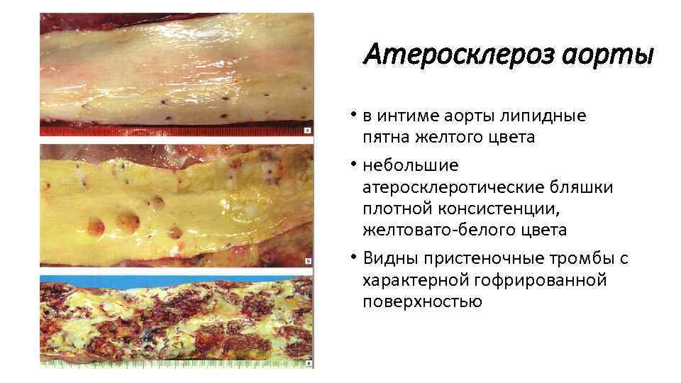 Атеросклероз аорты • в интиме аорты липидные пятна желтого цвета • небольшие атеросклеротические бляшки