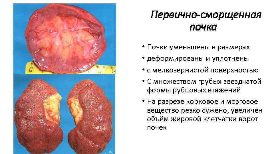 Первично-сморщенная почка • Почки уменьшены в размерах • деформированы и уплотнены • с мелкозернистой