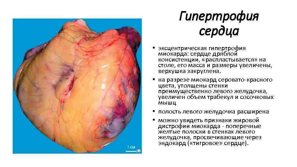 Гипертрофия сердца • эксцентрическая гипертрофия миокарда: сердце дряблой консистенции, «распластывается» на столе, его масса