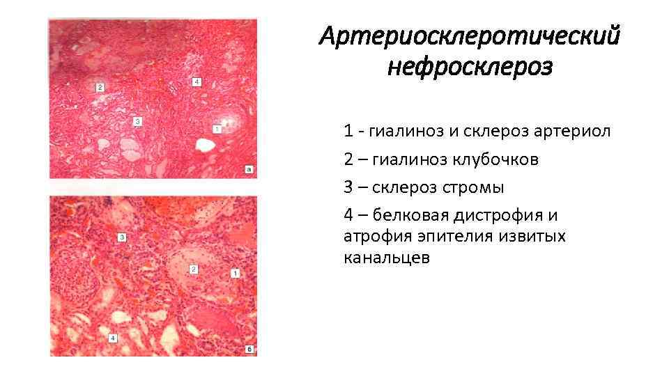 Артериосклеротический нефросклероз 1 - гиалиноз и склероз артериол 2 – гиалиноз клубочков 3 –