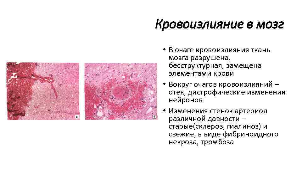 Кровоизлияние в мозг • В очаге кровоизлияния ткань мозга разрушена, бесструктурная, замещена элементами крови