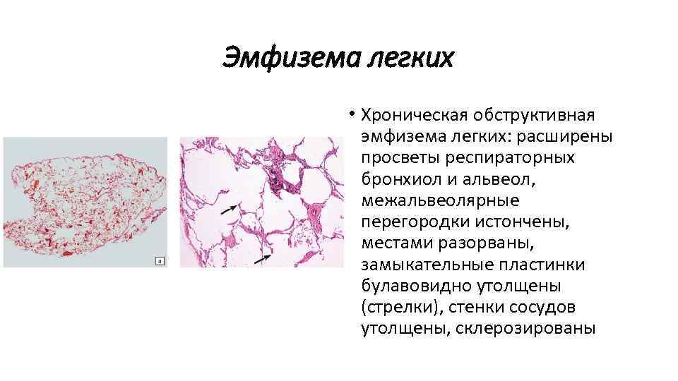 Эмфизема легких • Хроническая обструктивная эмфизема легких: расширены просветы респираторных бронхиол и альвеол, межальвеолярные