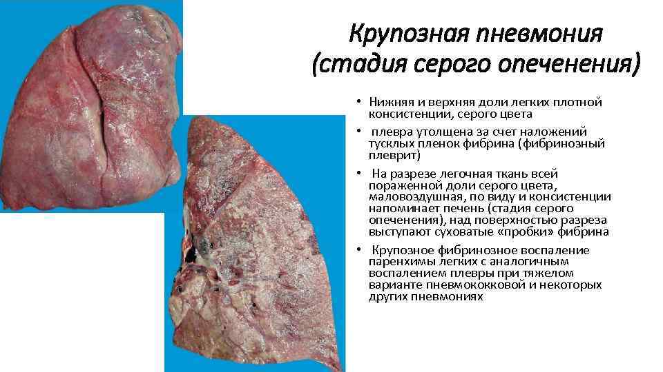 Крупозная пневмония (стадия серого опеченения) • Нижняя и верхняя доли легких плотной консистенции, серого