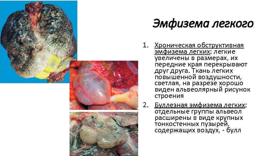 Эмфизема легкого 1. Хроническая обструктивная эмфизема легких: легкие увеличены в размерах, их передние края