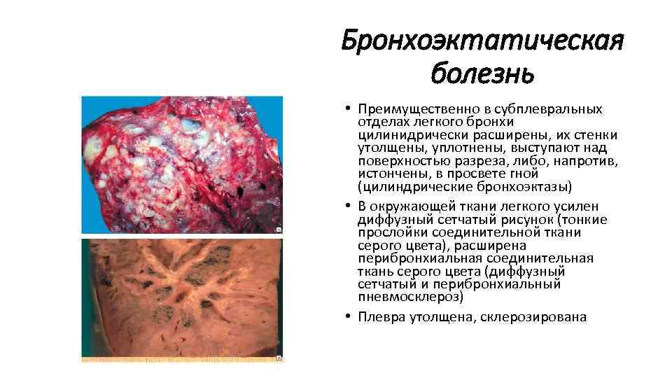 Бронхоэктатическая болезнь • Преимущественно в субплевральных отделах легкого бронхи цилинидрически расширены, их стенки утолщены,