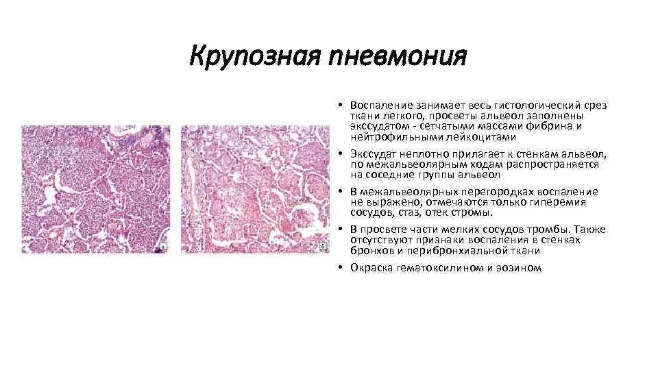 Основной возбудитель крупозной пневмонии