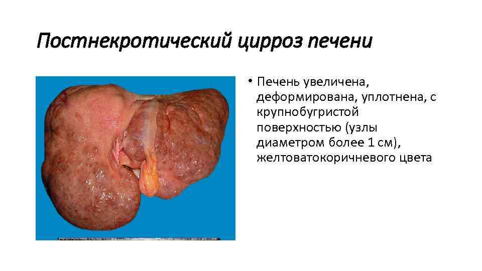 Постнекротический цирроз печени • Печень увеличена, деформирована, уплотнена, с крупнобугристой поверхностью (узлы диаметром более