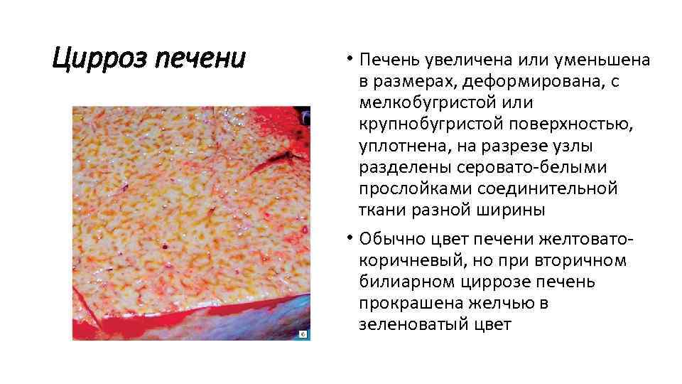 Цирроз печени • Печень увеличена или уменьшена в размерах, деформирована, с мелкобугристой или крупнобугристой