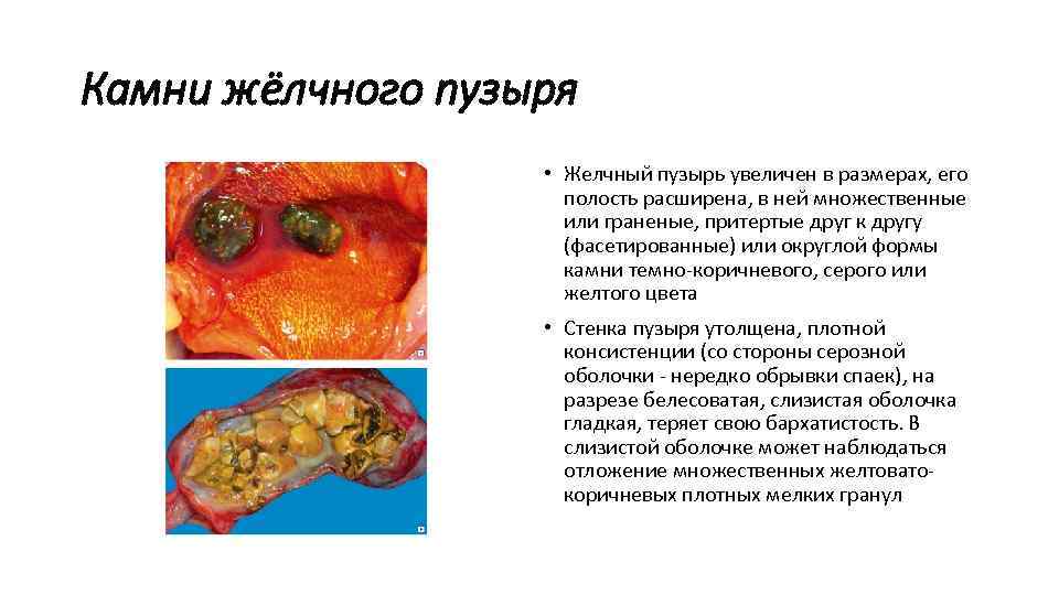 Камни жёлчного пузыря • Желчный пузырь увеличен в размерах, его полость расширена, в ней