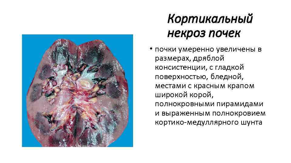Кортикальный некроз почек • почки умеренно увеличены в размерах, дряблой консистенции, с гладкой поверхностью,