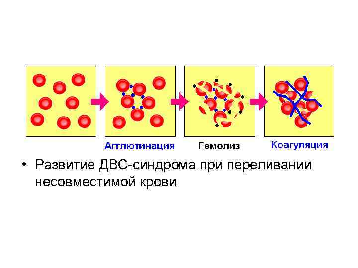  • Развитие ДВС синдрома при переливании несовместимой крови 