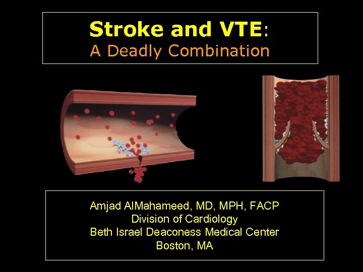 Stroke and VTE: A Deadly Combination Amjad Al. Mahameed, MD, MPH, FACP Division of
