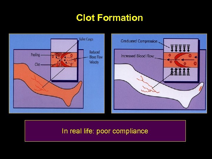 Clot Formation In real life: poor compliance 