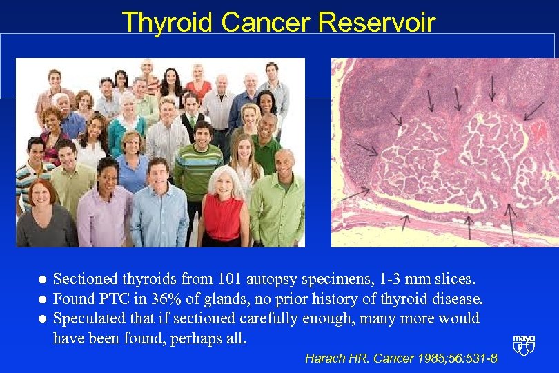 Thyroid Cancer Reservoir l l l Sectioned thyroids from 101 autopsy specimens, 1 -3