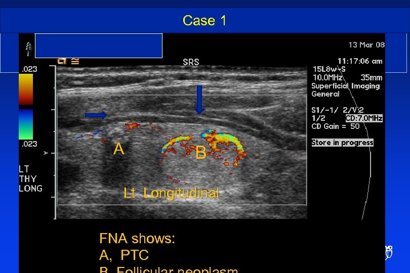 Case 1 Incidental PTC and benign thyroid nodule • . A B Lt Longitudinal