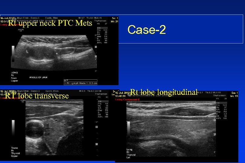 Rt upper neck PTC Mets RT lobe transverse Case-2 Rt lobe longitudinal 