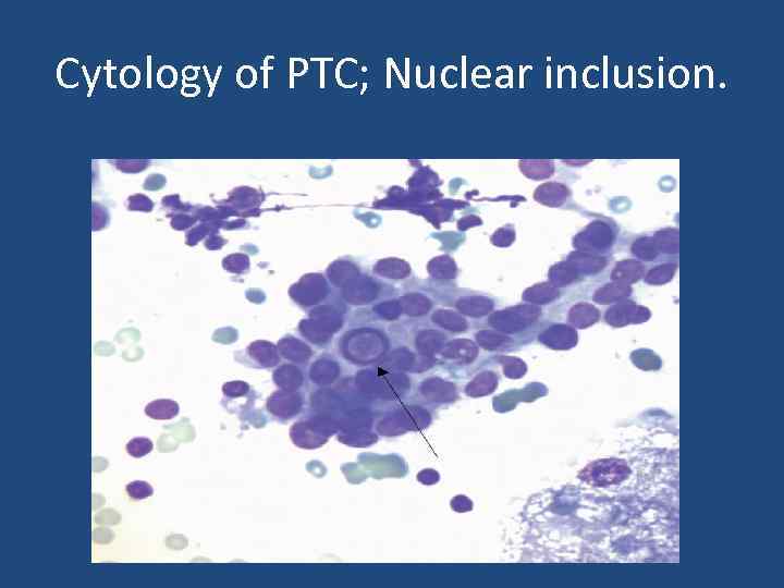 Cytology of PTC; Nuclear inclusion. 
