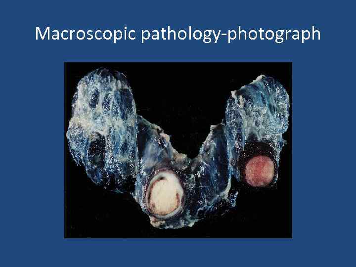 Macroscopic pathology-photograph 