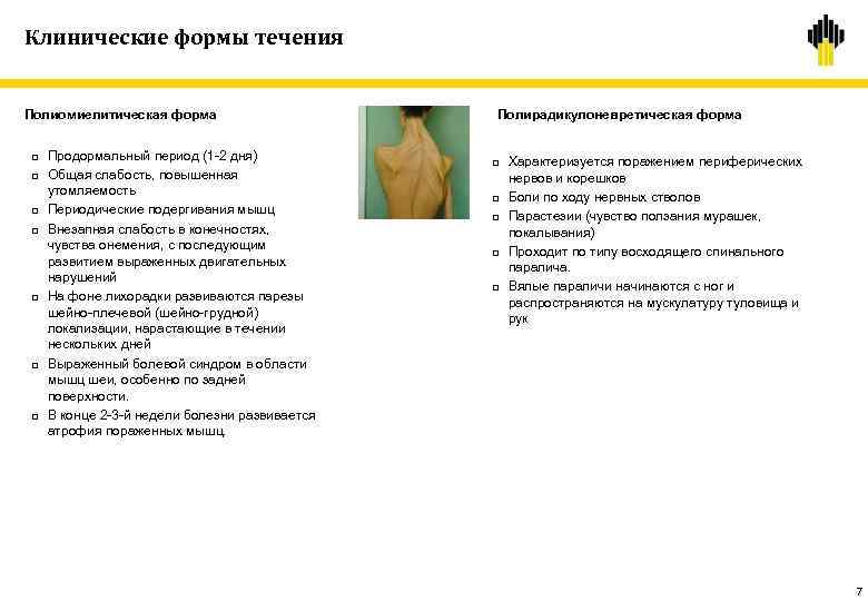 Клинические формы течения Полиомиелитическая форма q q q q Продормальный период (1 -2 дня)